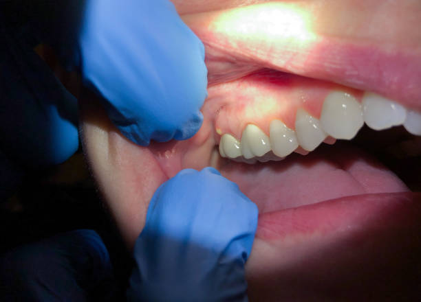 Best Dentist for Tooth Abscess  in Avalon, CA